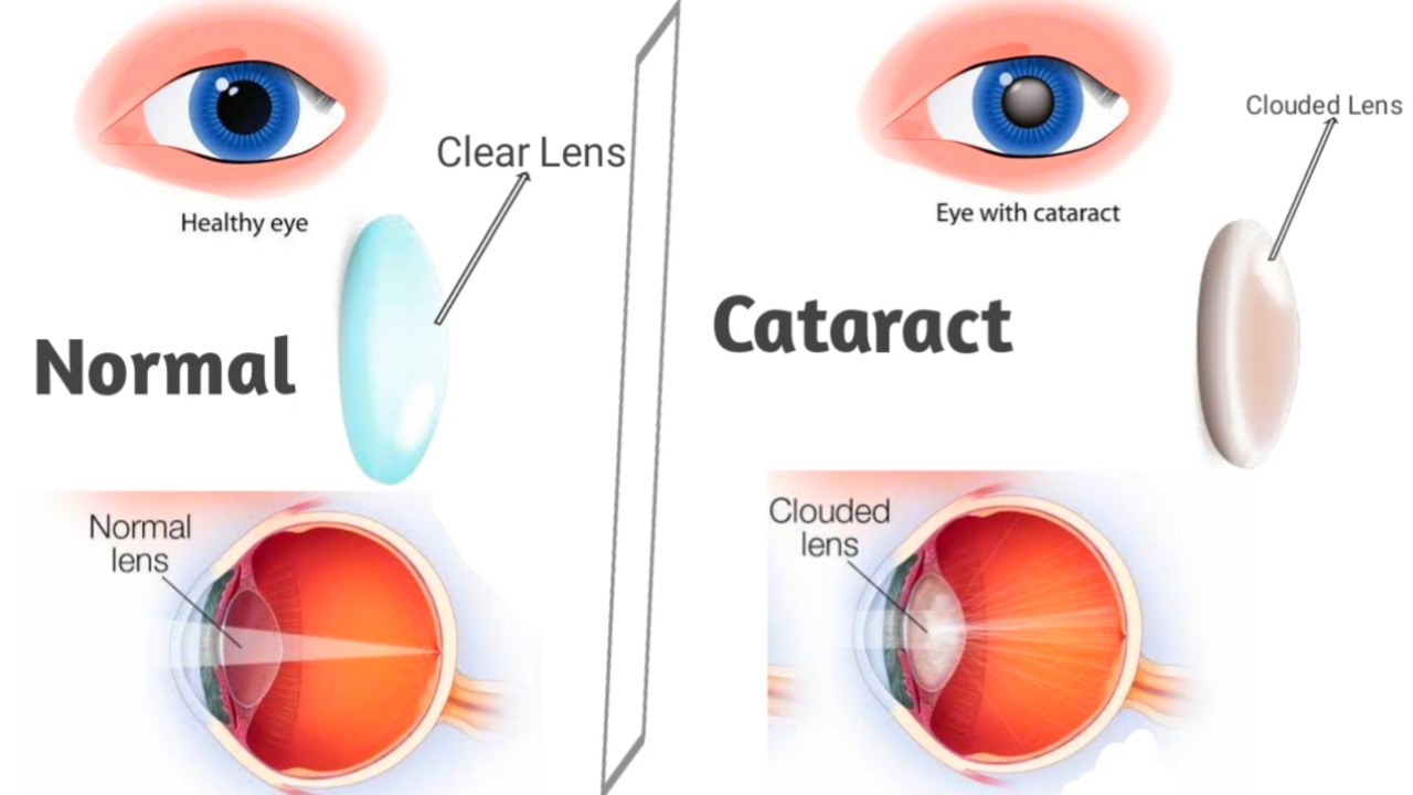 Cataract Causes Symptoms And Treatment Clinical Side 