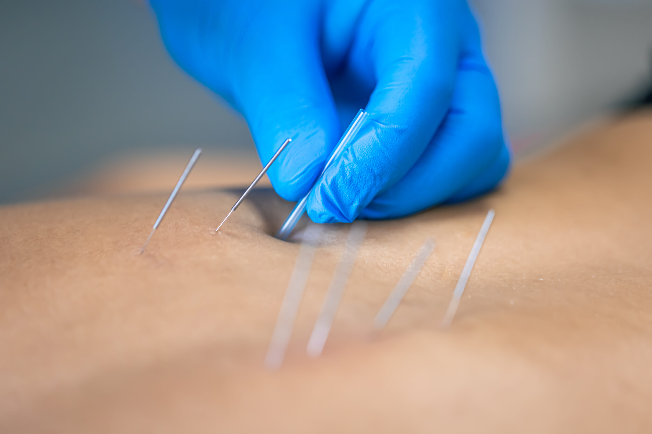Acupressure